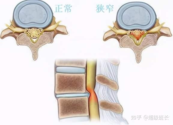 腰椎管狹窄手術(shù)成功率高嗎？都是怎樣做的？