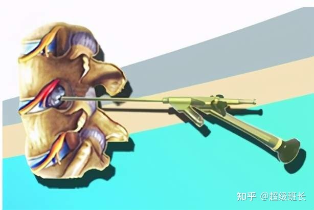 腰椎管狹窄手術(shù)成功率高嗎？都是怎樣做的？