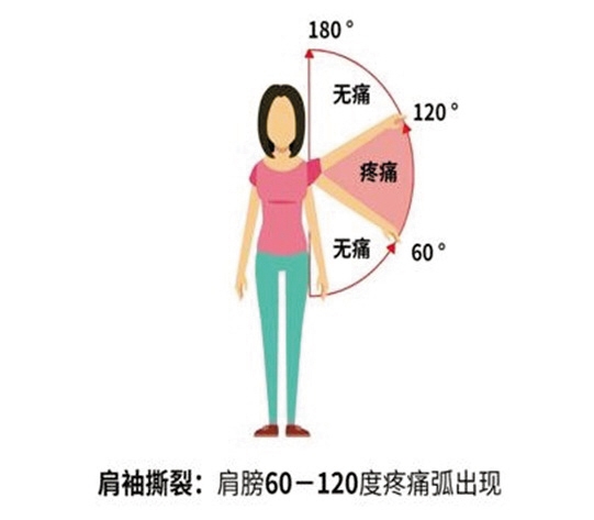 肩痛就是肩周炎？怎么分辨是不是肩周炎？
