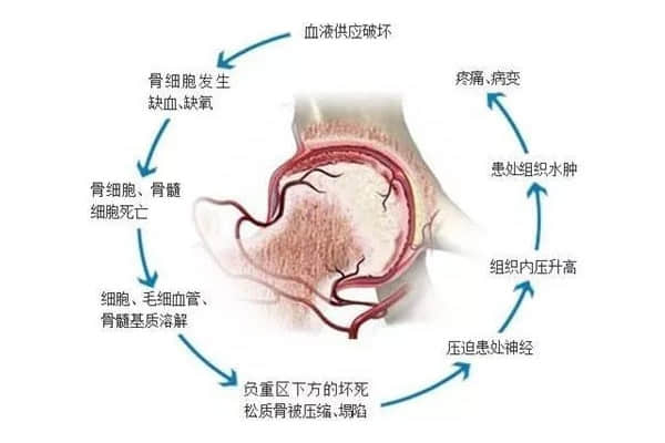 股骨頭壞死后股骨頭變形、塌陷怎么辦？