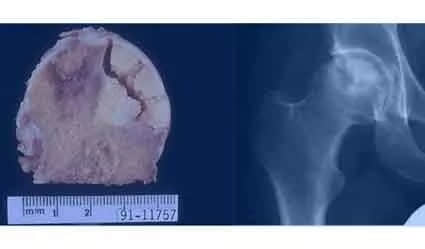 股骨頭壞死是怎樣一步步發(fā)展的？