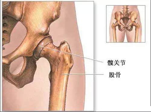 蓮池骨科醫(yī)院-股骨頭壞死患者，哪些情況下要做置換手術了？
