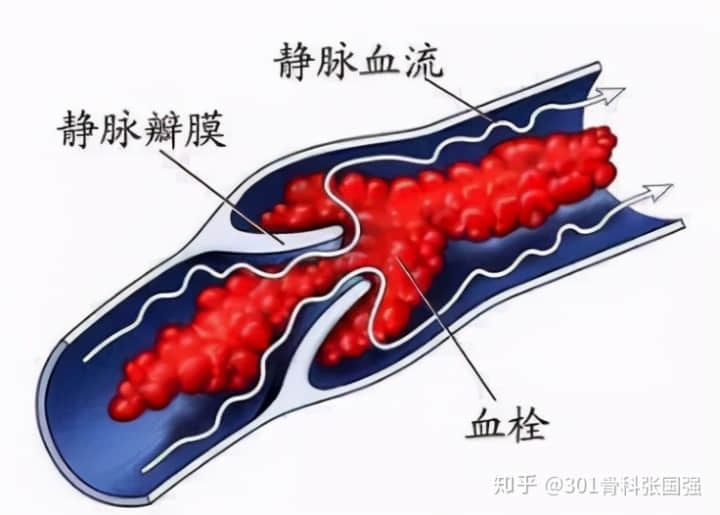 年齡「越大」，膝關(guān)節(jié)置換手術(shù)風(fēng)險(xiǎn)「越高」嗎？