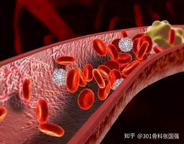 年齡「越大」，膝關(guān)節(jié)置換手術(shù)風(fēng)險(xiǎn)「越高」嗎？