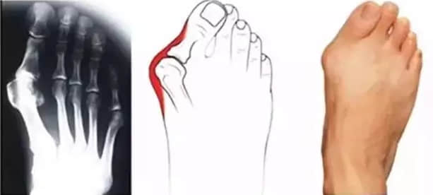 關(guān)于拇外翻，讀懂這一篇就夠了