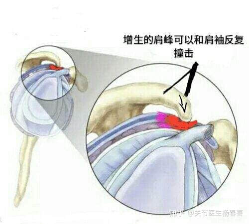 肩袖損傷與肩周炎可以用關(guān)節(jié)鏡治療嗎？