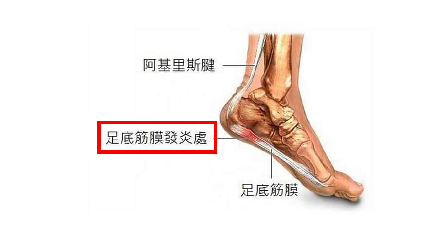 哪些人或者哪些習(xí)慣 容易患足底筋膜炎？