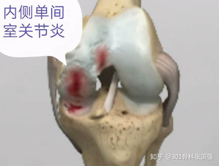 只有膝關(guān)節(jié)內(nèi)側(cè)疼也要換膝關(guān)節(jié)嗎？
