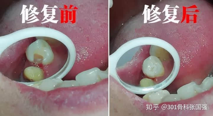 只有膝關(guān)節(jié)內(nèi)側(cè)疼也要換膝關(guān)節(jié)嗎？