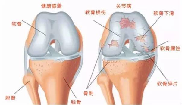 關(guān)節(jié)軟骨到底指什么？