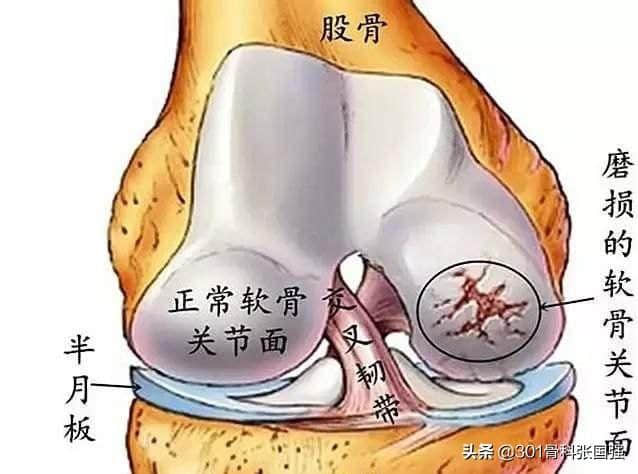 膝關節(jié)軟骨磨損了能復原嗎？