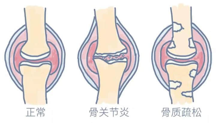 膝骨關(guān)節(jié)炎是一種老年常見(jiàn)病，多見(jiàn)于50歲以上人群，是引起老年人疼痛和殘疾的主要原因，常導(dǎo)致患者生活質(zhì)量下降。在門(mén)診中，我們經(jīng)常會(huì)碰到這樣的患者或家屬，他們關(guān)切的問(wèn)道：這個(gè)病能根治嗎，需要怎么治療？可以看出很多人對(duì)這一疾病還缺乏基本的認(rèn)知。

下面，我們來(lái)全面認(rèn)識(shí)下什么是膝骨關(guān)節(jié)炎。

★膝骨關(guān)節(jié)炎的概念★

膝骨關(guān)節(jié)炎還有一種說(shuō)法叫膝關(guān)節(jié)退行性變，通俗點(diǎn)說(shuō)就是關(guān)節(jié)老化了，這種老化的根源是關(guān)節(jié)軟骨的老化。

正常膝關(guān)節(jié)表面都有一層厚度約為3-5mm的軟骨，關(guān)節(jié)軟骨非常光滑，起到潤(rùn)滑、緩沖應(yīng)力的作用。

隨著年齡增長(zhǎng)軟骨會(huì)逐漸變薄，如果再伴有這些因素，比如：外傷，關(guān)節(jié)受力異常，韌帶或半月板損傷，先天發(fā)育不良，體重過(guò)大等，就會(huì)加速軟骨的磨損老化。

關(guān)節(jié)軟骨結(jié)構(gòu)的完整性非常重要，一旦損傷，會(huì)導(dǎo)致關(guān)節(jié)腫脹和疼痛，加速破壞，發(fā)展成骨關(guān)節(jié)炎。

由于關(guān)節(jié)軟骨中沒(méi)有血管，其營(yíng)養(yǎng)物質(zhì)依靠關(guān)節(jié)液供應(yīng)，其本身也不含可以分化再生的細(xì)胞，一旦損傷后很難自我修復(fù)或再生。

雖然近幾年來(lái)對(duì)于軟骨修復(fù)和軟骨再生的研究有了一些成果，但現(xiàn)階段來(lái)看，對(duì)于老年骨關(guān)節(jié)炎的軟骨再生是不可能的。








圖：左側(cè)為健康的膝關(guān)節(jié)（軟骨完整），右側(cè)為骨關(guān)節(jié)炎的膝關(guān)節(jié)炎（軟骨破壞）

所以說(shuō)膝骨關(guān)節(jié)炎是不可能治愈的，但是對(duì)于不同嚴(yán)重程度的膝骨關(guān)節(jié)炎，通過(guò)正確有效的治療，可以緩解或消除疼痛，延緩關(guān)節(jié)老化速度，改善或恢復(fù)關(guān)節(jié)功能，提高患者的生活質(zhì)量，實(shí)現(xiàn)臨床治愈。

那么該如何正確有效的治療呢？

★膝骨關(guān)節(jié)炎的治療★

膝骨關(guān)節(jié)炎可根據(jù)疼痛及對(duì)日常活動(dòng)的影響程度分為初期、早期、中期和晚期，針對(duì)不同分期，有不同的治療策略。








中華醫(yī)學(xué)會(huì)《骨關(guān)節(jié)炎診療指南》2018 年版，針對(duì)不同分期的膝骨關(guān)節(jié)炎提出基礎(chǔ)治療、藥物治療、修復(fù)性治療和重建治療四層次的金字塔型的階梯治療策略。

基礎(chǔ)治療
基礎(chǔ)治療包括：健康教育，運(yùn)動(dòng)治療，物理治療和行為支持治療。對(duì)癥狀較輕的初期患者這是首選的治療方式。強(qiáng)調(diào)改變生活及工作方式的重要性，使患者樹(shù)立正確的治療目標(biāo)，減輕疼痛、改善和維持關(guān)節(jié)功能，延緩疾病進(jìn)展。

藥物治療
按藥物使用途徑分為外用藥物、口服藥物、關(guān)節(jié)腔內(nèi)注射藥物等。

口服藥物：在使用口服藥物前，建議先選擇局部外用藥物，尤其是老年人，可使用各種NSAIDs類(lèi)藥物的凝膠貼膏、乳膠劑、膏劑、貼劑等，如氟比洛芬凝膠貼膏、扶他林乳膏等?？诜幬镏凶畛Ｓ玫氖荖SAIDs類(lèi)鎮(zhèn)痛藥，但要注意NSAIDs類(lèi)藥物過(guò)量使用并不能增強(qiáng)療效、可能會(huì)增加毒副反應(yīng)。

關(guān)節(jié)腔注射藥物：對(duì)早中期可緩解疼痛，改善關(guān)節(jié)功能，但該方法是侵入性治療，可能會(huì)增加感染的風(fēng)險(xiǎn)，必須嚴(yán)格無(wú)菌操作及規(guī)范操作，而且最新的國(guó)際指南并不推薦關(guān)節(jié)腔注射。

手術(shù)治療
修復(fù)性治療包括：關(guān)節(jié)鏡手術(shù)，關(guān)節(jié)軟骨修復(fù)術(shù)及生物治療，膝關(guān)節(jié)周?chē)毓切g(shù)。

關(guān)節(jié)鏡清理：主要針對(duì)伴有“膝關(guān)節(jié)卡頓”或半月板撕裂等癥狀的患者，通過(guò)關(guān)節(jié)鏡下摘除游離體、清理半月板碎片及增生的滑膜等，能減輕部分早中期患者的癥狀，但有研究認(rèn)為其遠(yuǎn)期療效與保守治療相當(dāng)，最新的國(guó)際指南也不推薦關(guān)節(jié)鏡手術(shù)作為癥狀性骨關(guān)節(jié)炎患者的治療手段。

關(guān)節(jié)軟骨修復(fù)術(shù)及生物治療:療效尚需進(jìn)一步研究探索。

膝關(guān)節(jié)周?chē)毓切g(shù)：是經(jīng)典的保膝治療手段，最常用的是脛骨高位截骨術(shù)（HTO）。該方法通過(guò)改變力線來(lái)改變關(guān)節(jié)面的接觸面，就像是一顆小樹(shù)長(zhǎng)歪了，我們通過(guò)外力把它變直。該方法可以有效緩解甚至消除疼痛，大部分患者可不需再行關(guān)節(jié)置換。該方法適合青中年活動(dòng)量大、力線不佳的患者。


重建性手術(shù)：主要是人工關(guān)節(jié)置換術(shù)，包括膝關(guān)節(jié)部分置換術(shù)（單髁置換術(shù)）和全膝關(guān)節(jié)置換術(shù)。


單髁置換術(shù)：適用于當(dāng)膝關(guān)節(jié)的軟骨只有一個(gè)地方受累，而且關(guān)節(jié)韌帶功能完好的情況下。這是一種微創(chuàng)手術(shù)，該技術(shù)能盡可能保留正常的關(guān)節(jié)結(jié)構(gòu)，具有創(chuàng)傷小，恢復(fù)快，術(shù)后關(guān)節(jié)自我感覺(jué)好等優(yōu)點(diǎn)，十年優(yōu)良率在95%左右。但是當(dāng)關(guān)節(jié)軟骨多個(gè)部分或全部都受累時(shí)，單髁置換就不能解決問(wèn)題了。這時(shí)需要全膝關(guān)節(jié)置換。


全膝關(guān)節(jié)置換術(shù)：是針對(duì)終末期骨關(guān)節(jié)炎成熟且有效的治療方法，尤其是伴有各種嚴(yán)重畸形時(shí)，能非常有效的解除患者病痛，極大提高患者生活質(zhì)量。術(shù)后絕大多數(shù)患者遠(yuǎn)期效果滿(mǎn)意，15-20年假體生存率可達(dá)90%。

結(jié)語(yǔ)
隨著人類(lèi)壽命的延長(zhǎng)，人口老齡化，骨關(guān)節(jié)炎的發(fā)生率逐年增加，嚴(yán)重影響人們的生活質(zhì)量和健康，給社會(huì)造成巨大的經(jīng)濟(jì)負(fù)擔(dān)和壓力。所以，從年輕時(shí)我們就該引起重視，預(yù)防骨關(guān)節(jié)炎的發(fā)生。在出現(xiàn)癥狀的骨關(guān)節(jié)炎初期、早期，要正確認(rèn)識(shí)，通過(guò)積極的基礎(chǔ)治療和藥物治療，盡可能減緩病情進(jìn)展。

當(dāng)中晚期時(shí)，要根據(jù)病情、年齡、社會(huì)活動(dòng)的不同層次，以及關(guān)節(jié)間室累及情況，選擇合適的手術(shù)方案。特別是當(dāng)疼痛癥狀較重，嚴(yán)重影響生活質(zhì)量時(shí)，應(yīng)盡早進(jìn)行手術(shù)治療，而不是往后拖。