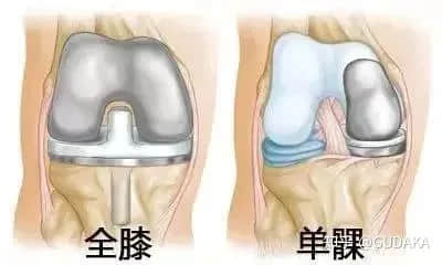 膝關(guān)節(jié)還能換半邊？UKA單髁置換是什么