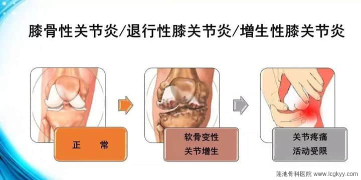 膝骨性關(guān)節(jié)炎，“保膝”“換膝”如何選？