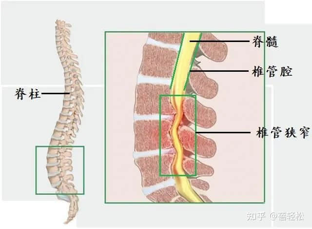 椎管狹窄是什么意思？嚴(yán)重嗎?