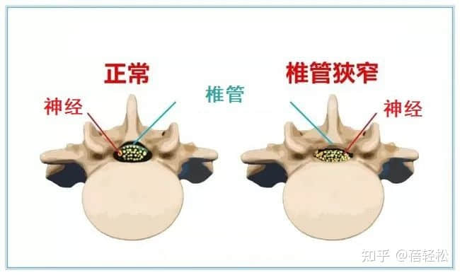 椎管狹窄是什么意思？嚴(yán)重嗎?