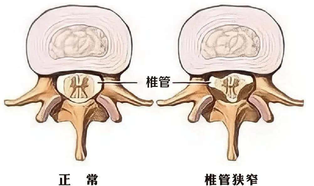 腰椎椎管狹窄癥？試試UBE技術！