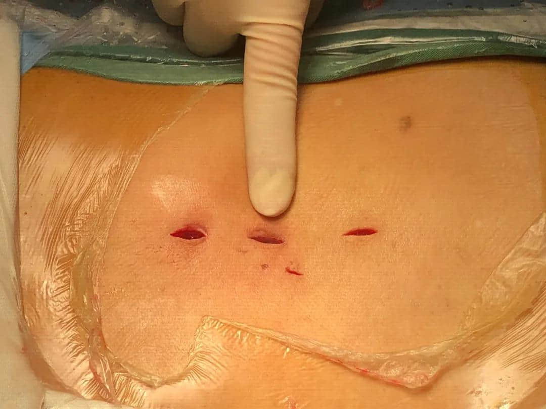 腰椎椎管狹窄癥？試試UBE技術！