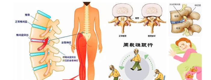 老年腰突癥與年輕患者有什么不同？哪些方法更適合？